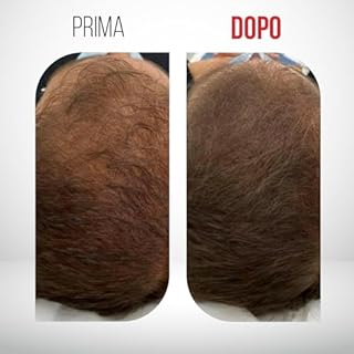 Restax 30+30 per alopecia androgenetica maschile. Antiandrogeno, ferma caduta di capelli e stimola ricrescita, softgel in olio di serenoa repens con massima purezza e dosaggio, formulazione bifasica