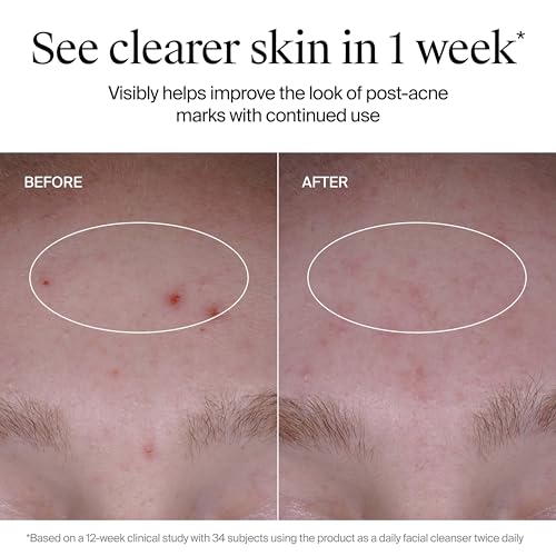 Neutrogena Evenly Clear Acne Cleanser, 9.1 fl. oz | 2% Salicylic Acid, 2% PHA Exfoliant, Gentle Foaming Face Wash, Clears Clogged Pores & Blackheads - image 6