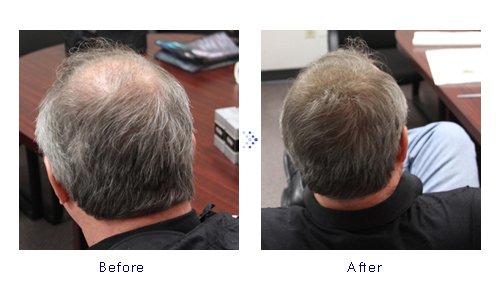 Miniatura 3 de Forila Corrector de pérdida de cabello de fibras de construcción de cabello, 0.81 oz - marrón oscuro