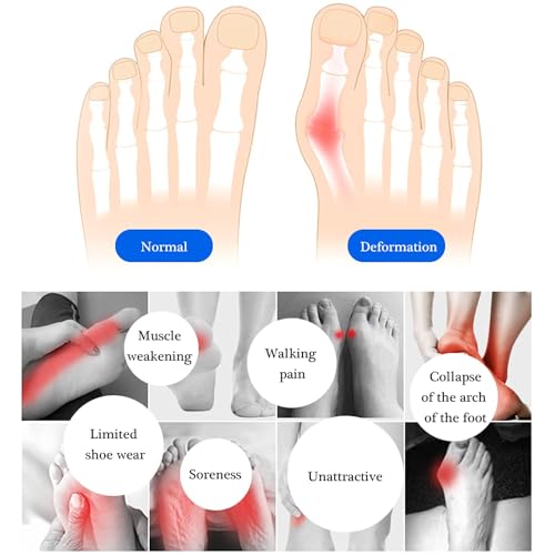 Image of SooGree 2 Pairs Honeycomb Fabric Forefoot Pads Men Women Soft Metatarsal Foot Pads Soft Gel Ball of Foot Cushions for Pain Relief