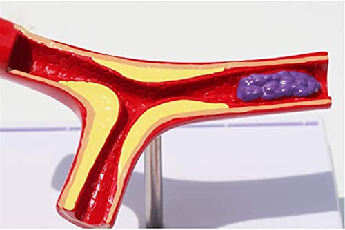 Anatomie Model, Educatief Model Anatomie Atherosclerose Model Trombus Trombose Vasculair Model Arterieel Bloedvat… - Image 4