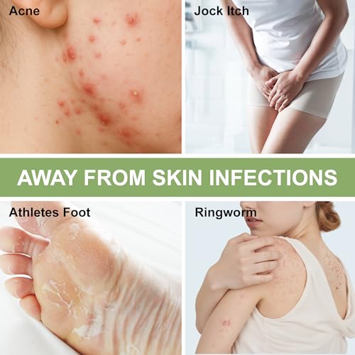 Antifungal soap bar used for athlete foot and skin issues