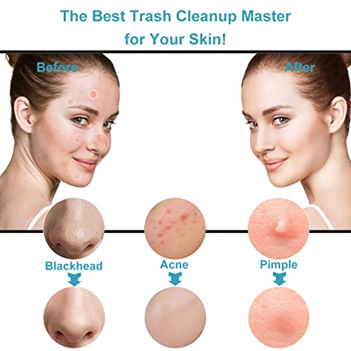 Blackhead Remover Tools, Vboo Pimple Popper Tool Kit, Extraction Tools For Nose Facial Pore, Comedone Zit Popper Tool, Blemish Whitehead Extractor Tool, For Women Men’s Christmas Present (Silver) #TOP3
