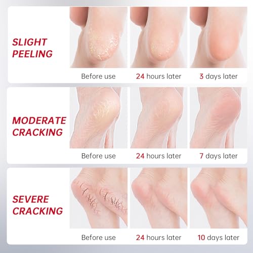 OCSINL Urea Cream 40 Percent for Feet Maximum Strength, with Heel Protectors, Foot Moisturizer Cream for Dry Cracked Heels Rough Dead Dry Skin Foot Callus Remover - 5.29 Oz