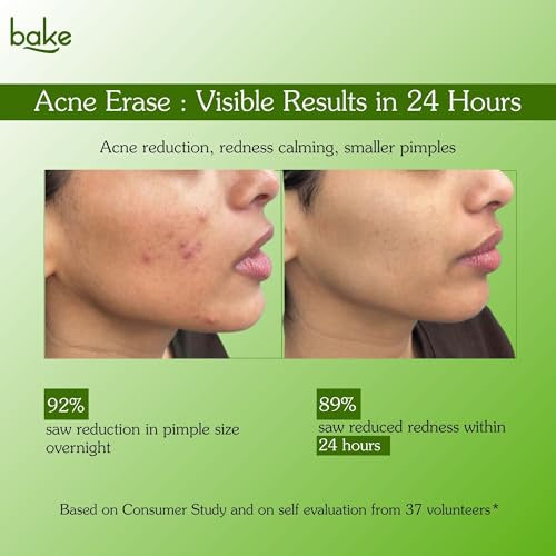 Image of BAKE Acne Spot Treatment Serum Gel with 2% Sulfur, 2% Salicylic Acid + 0.5% Salicap CSA for Pimples & Breakouts | 5% Niacinamide + 2% Azealic Acid | Clears Blackheads, Whiteheads & Clogged Pores | Reduces Redness & Excess Oil | Overnight Acne Corrector - 30g