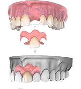 Amazon.co.jp: Dentellea カスタム マウスピース 2個セット 上下対応