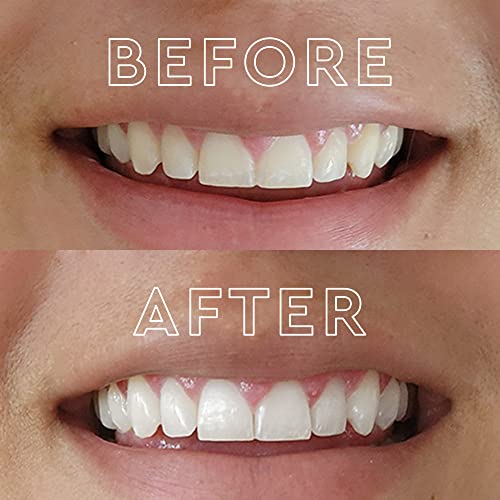Moon Teeth Whitening Kit With Led Light, Wireless, 5 Minute Treatment, Gentle On Teeth, Helps Remove Stains From Coffee, Smoking, Wine, Soda #TOP1