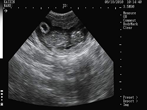 Ultrasound image showing a fetal sac