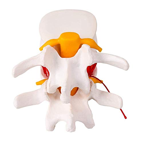 Image of Premium ✮ Lumbar Disc Herniation Model ✮ Lumbar Spine Model for Teaching & Learning ✮ Excellent Way for Demonstrating Herniated Lumbar Disc