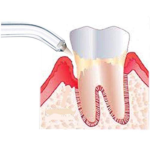 YanBan 2 peças de substituição Pontas periodontais para Waterpik, irrigador bucal de água dentária p
