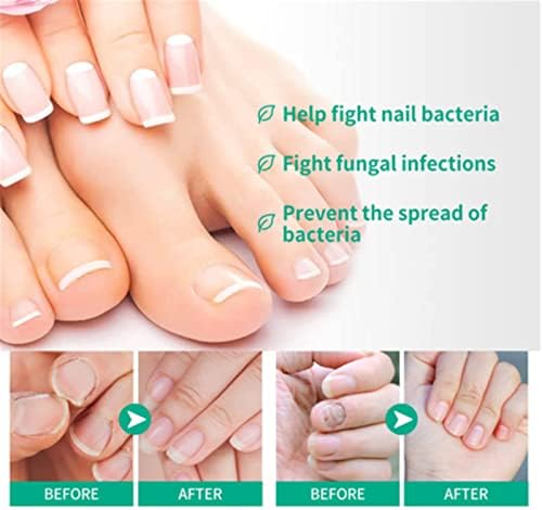 Kerassentials for Toenail Fun_gus, Kerassentials Toenail Fun_gus Treatment Oil, Kerasentials Nail Treatment Kerassentials, Healthy Natural Repair Nails (1Pcs)