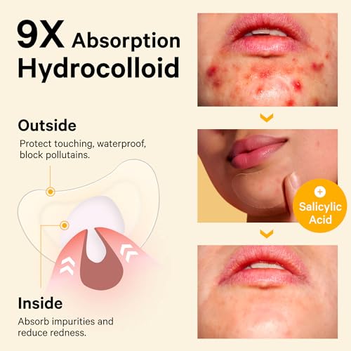 Image of Sosky Chin Pimple Patches Hydrocolloid Acne Patches for Breakouts Large Spot Control Covers for Face Chin & Body Vegan Cruelty Free (10 Count)