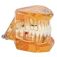 Zahnmodell Zahnkrankheits-Lehrmodell Abnehmbares Implantat Zahnmodell Mundmodell für Erwachsene für den Zahnärztlichen Unterricht