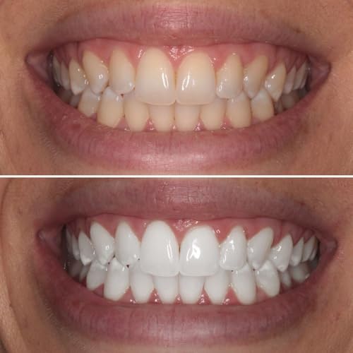 Teeth Whitening: How to Achieve a Brighter Smile Safely