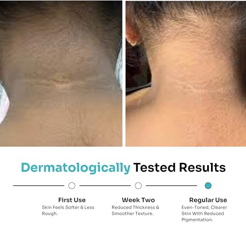 Image of Kitcoz Nigriclear Cream for Pigmentation (Acanthosis Nigricans) with Urea, Retinol & Lactic Acid | Treats Dark, Dry & Rough Skin Patches on Neck, Elbow, Knees, Armpits & Thighs | Diabetes Skin Care | Daily Use Safe - Men & Women (50gm)