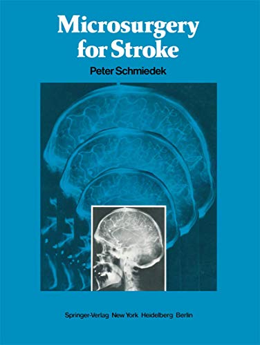 Microsurgery for Stroke view 2
