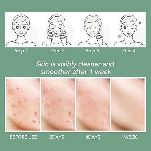 Akne Behandlung Anti Akne Spot Pickel Creme Makel Breakout Behandlung Gesicht Akne Narbenentfernung Gel-Creme reduziert Rötungen natürliche Hautpflege (60 g) - Image 5