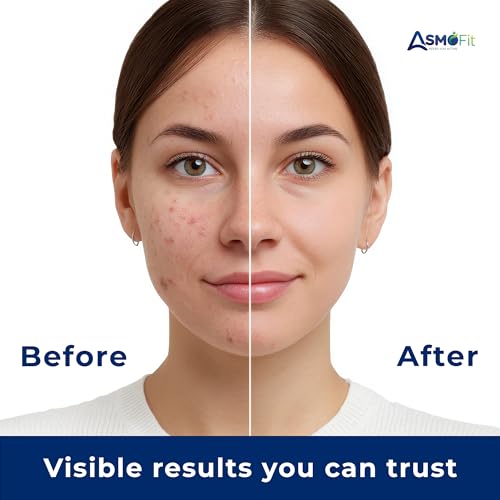 Image of ASMOFIT Acne Pimple Patch for Face | 72 Hydrocolloid Pimple Patches | 2 Percent Salicylic Acid | Invisible Waterproof Acne Patches for Whiteheads | Day and Night Use