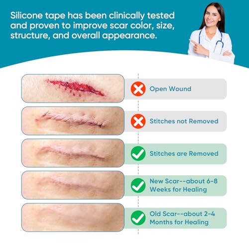 VPRIME SAFETYFY Silicone Scar Tape, Silicone Scar Sheets for Surgical Scars (1.6"x 80" Roll-2M), Medical Ggrade Scar Tape for Scars, Keloid, Acne Scars, Burn, C-Section, Stretch Marks Scars Away — view 6