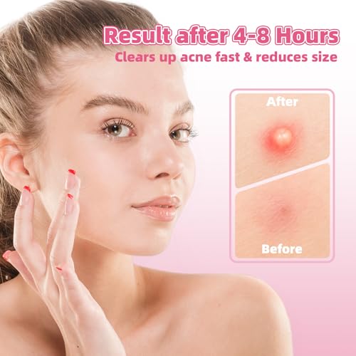 Pickel Patch 108 Stück Unsichtbare - Hydrokolloid Pimple Patches Natürliche, Pimple Patch Pickel Absorbierendes Pflaster für Gesicht, Acne P atch Nacht 2-In-1 Wasserdicht für die Hautpflege