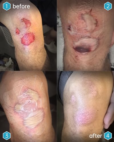 yehooheal Hydrocolloid Adhesive Bandages Dressing,0.004inch Ultra-Thin Skin-Like Waterproof Faster Healing Patch,for Home Travel First Aid Wound Care Sensitive Skin(2.36in*2.36in, 5Count)