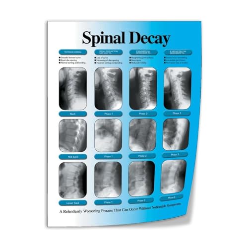Spinal Degeneration Stages Health Poster (6) Canvas Print Wall Art
