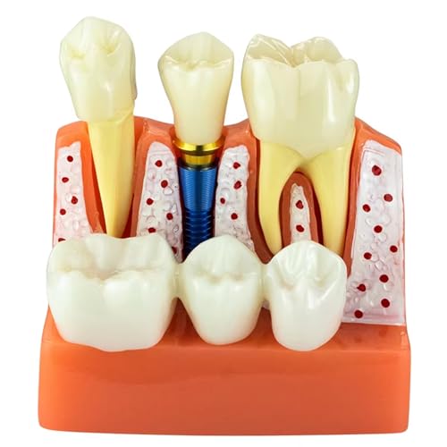 Dental Implant Model, 4 Times Transparent Teeth Model with Analysis Crown Bridge for Stutent Study and Teaching Demonstration (Red)