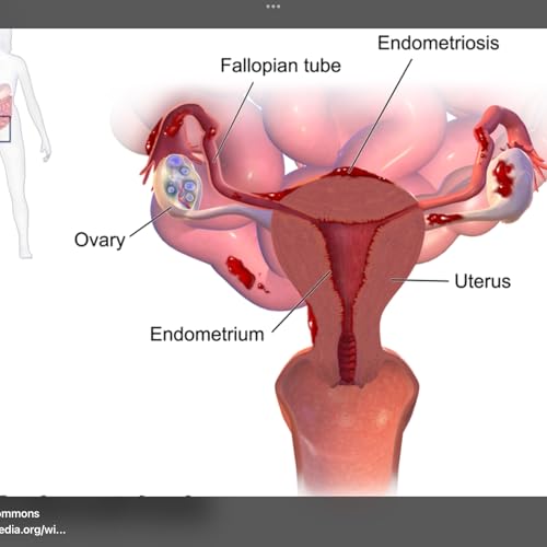Endometriosis &mdash; A Fresh Look for Everyone
