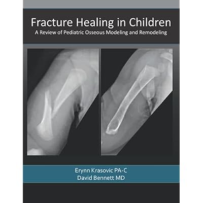 Fracture Healing in Children