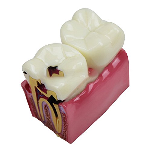 Pevor New Dental Teeth Model Dental Caries Tooth Model Patient Education Teeth Model 6 Times Caries