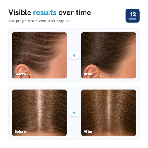 Image of Be Bodywise Advanced Hair Density Roll-On Serum 50 ml | 5% Saw Palmetto, 3% Rosemary, 1% Caffeine Herbasome & 3% Fenugreek | Scalp Serum for Reduced Hair Fall | Men & Women
