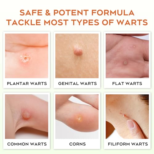 Image of inchSTAY STOKED inch Wart Remover, 15 ml Skin Tag Remover Freeze Off - Plantar Wart Remover for Feet with Salicylic Acid - Best Wart Removal for Common Wart-6SZ