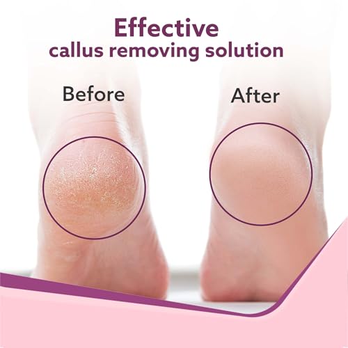 AGARO Callus Remover with 3 Interchangeable Head Rollers, Electronic Foot Scrubber for Callus & Dead Skin Removal, Pedicure Device, 2 Speed,... - Image 5