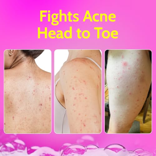 Chemist at Play Store Chemist at Play 1% Salicylic Acid Acne Body - Image 7