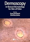 Dermoscopy in General Dermatology for Skin of Color