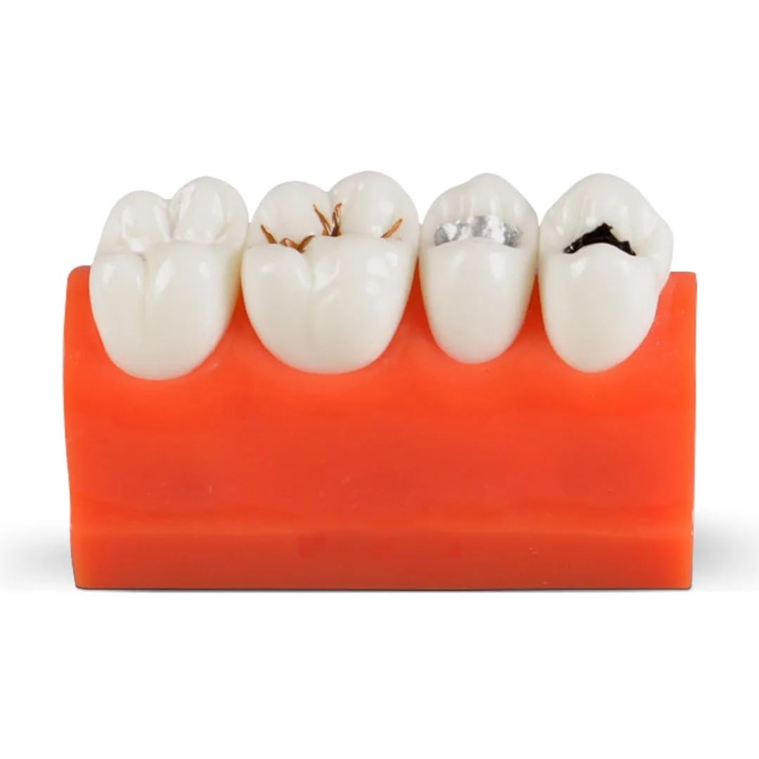 Dental Tool Caries Model (Pack Of 1)-picture-16