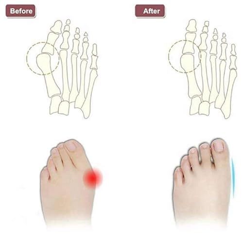 CLSQLXYJZC Summer Bunion Sandals, Slip-On Leather Breathable Bunion Corrector Sandals for Men, Casual Soft Non-slip Foot Correction Clip Toe Flip Flops, for Dad, Big Toes Bent Toes and Pain Relief4