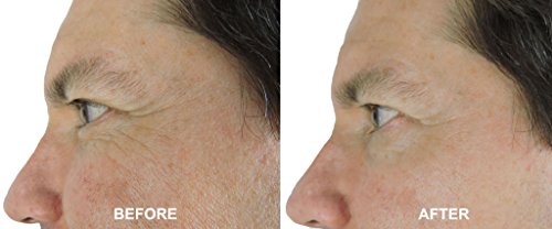 Dna Code®-No Needle Alternative-Pure Argireline Peptides Wrinkle Reduce Serum+ Matrixyl 3000+Hyaluronic Acid #TOP3