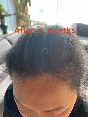 Luxuriant Hair Growth Serum - Anti-Dandruff, Hair Loss, and Scalp Treatment | DHT Blocker | Essential Oil Hair Growth for Men and Women | (1 x 100 ml) - Image 5