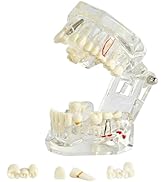 Transparent Dental Implant Model with Pathology for Educational Purposes - Demonstrative Implant ...