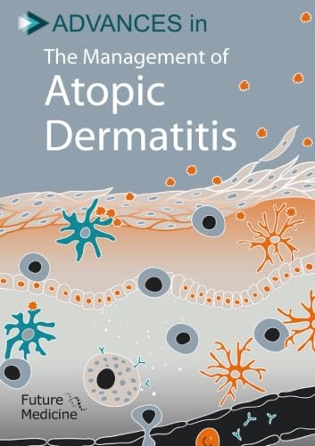Advances in the Management of Atopic Dermatitis : Amazon.in: Books