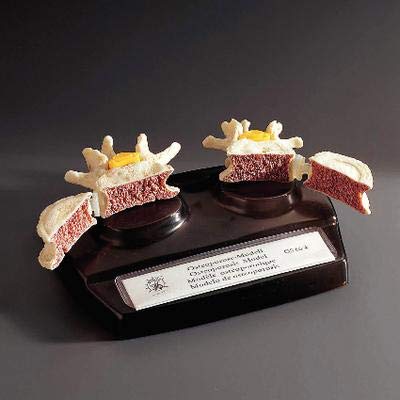 QS 66/4 - Osteoporosis - Somso Osteoporosis Model - Each