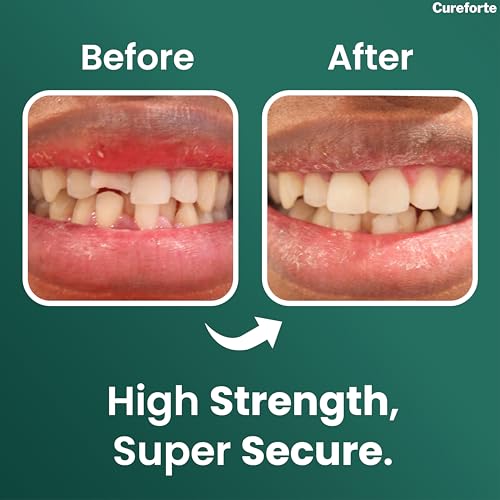 Cureforte Zinc Oxide Eugenol Dental Cement Kit – Professional Temporary Crown & Bridge Glue for Tooth Fillings | Self-Curing, Strong Bond, and Pulp-Soothing Formula | Easy-to-Use Dental Repair Kit