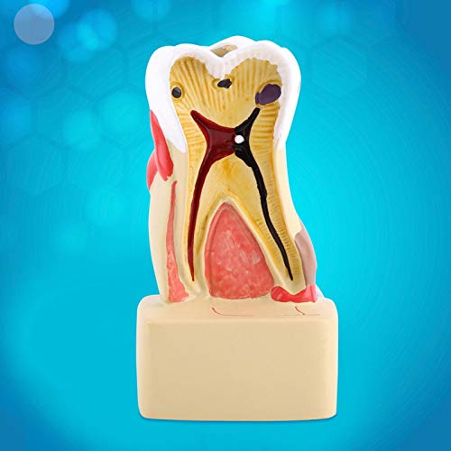 Tandheelkundige ziekte Tand Model Uitgebreide Cariës Model Tandarts met Zenuw voor Tandarts Studie Onderwijs - Image 6