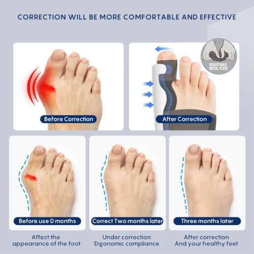 Image of Bunion Corrector for Women and Men| Toe Separator Both 2 Feet Bunion Splint, Big Toes Separation Pain Relief, Non-Surgical Adjustable Hallux Valgus Bunions Thumb Straightener, Hammer Toe Day Night Support (Pack of 1)