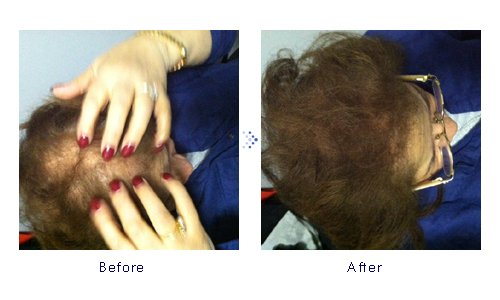 Miniatura 6 de Forila Corrector de pérdida de cabello de fibras de construcción de cabello, 0.81 oz - marrón oscuro