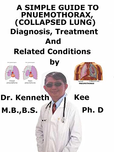 A Simple Guide To Pneumothorax (Collapsed Lungs), Diagnosis, Treatment And