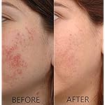 Vitamin C Serum 20% Pure L-Ascorbic Acid, Ferulic Acid, Vitamin E and HA and Hyaluronic Acid Serum with Vitamin B5 for Face and Eyes Natural Anti Aging Anti Wrinkle Set of 2 by Dr. Brenner - Image 4