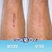 Scar Zone Advanced Scar Removal Cream - Scar Cream for Surgical Scars, Stretch Marks Removal, C Section & Fades Old & New Scars (0.75 oz, Pack of 3)