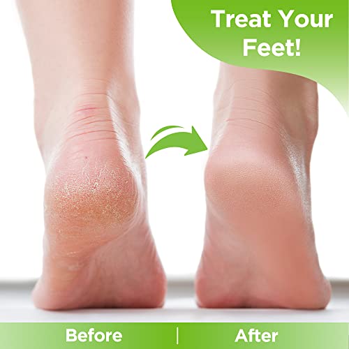 Natural Tea Tree Foot Soak Salts For Foot Recovery - Epsom Salt Foot Soak, Foot Bath Soak, Foot Salt Soak - Pedicure Foot Soak, Foot Spa Soak, Foot Soak For Dry Cracked Feet, Athletes Foot Soak #TOP4